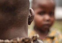 Understanding MPOX: Strategies for Containment and Prevention news-16082024-132053