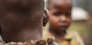 Understanding MPOX: Strategies for Containment and Prevention news-16082024-132053