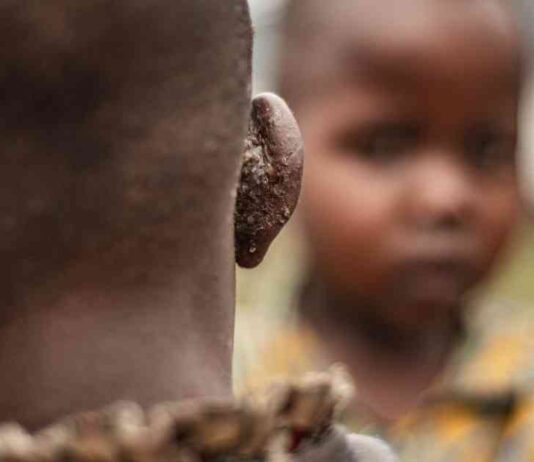 Understanding MPOX: Strategies for Containment and Prevention news-16082024-132053